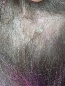 Plaque attached to scalp