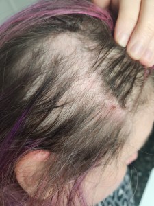 Severe hair loss from psoriatic arthritis